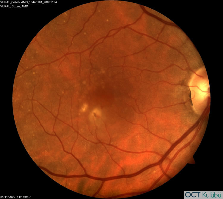 Retinal Anjiomatöz Proliferasyon