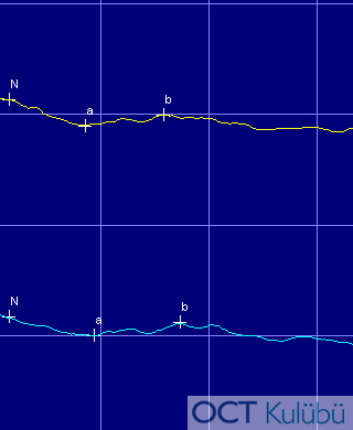 Kon Distrofisi
Elektrofizyolojik Testler