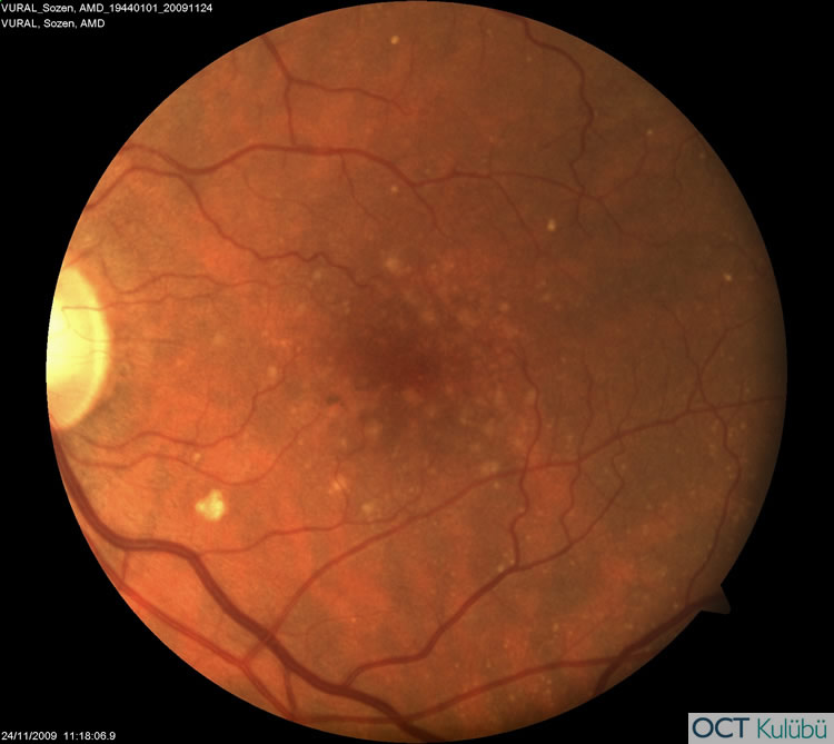 Retinal Anjiomatöz Proliferasyon