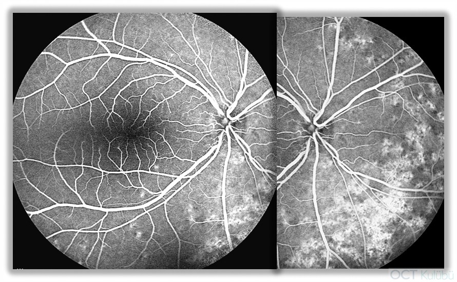 Nanoftalmus Flöresein anjiografi