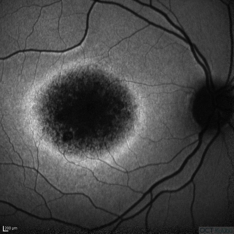 Kon Distrofisi
Fundus Otoflöresans