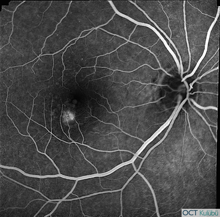 Retinal Anjiomatöz Proliferasyon
Flöresein anjiyografi