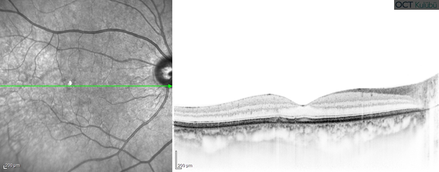 Polipoidal Koroidal Vaskülopati
Optik koherens tomografi (OCT)