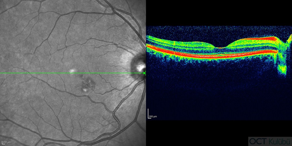 Pakikoroid Pigment Epitelyopati
Optik koherens tomografi