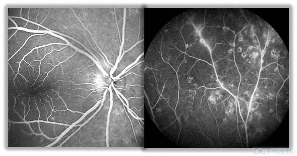 Nanoftalmus Flöresein anjiografi