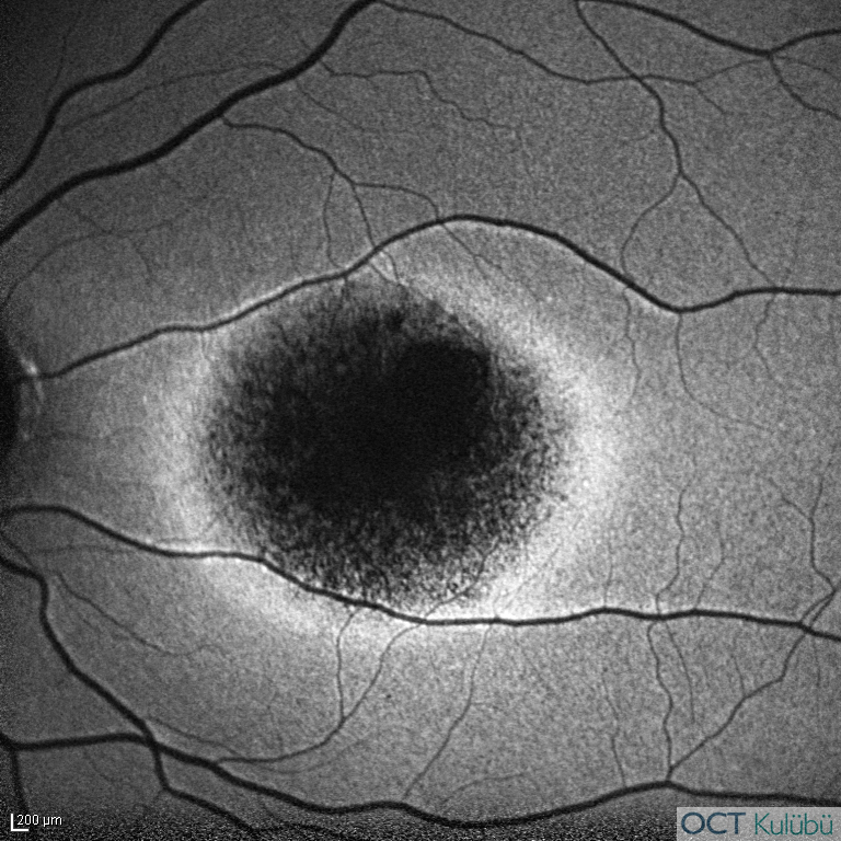 Kon Distrofisi
Fundus Otoflöresans