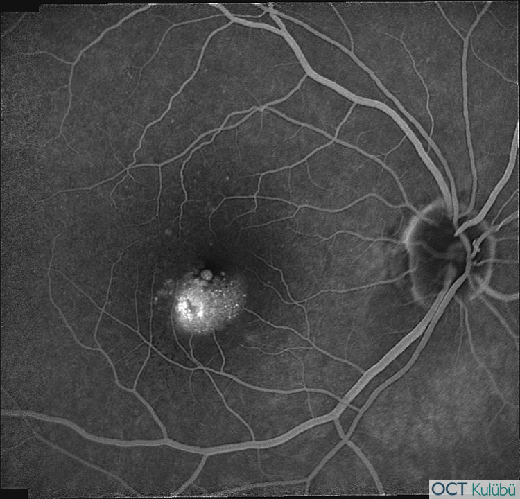 Retinal Anjiomatöz Proliferasyon
Flöresein anjiyografi