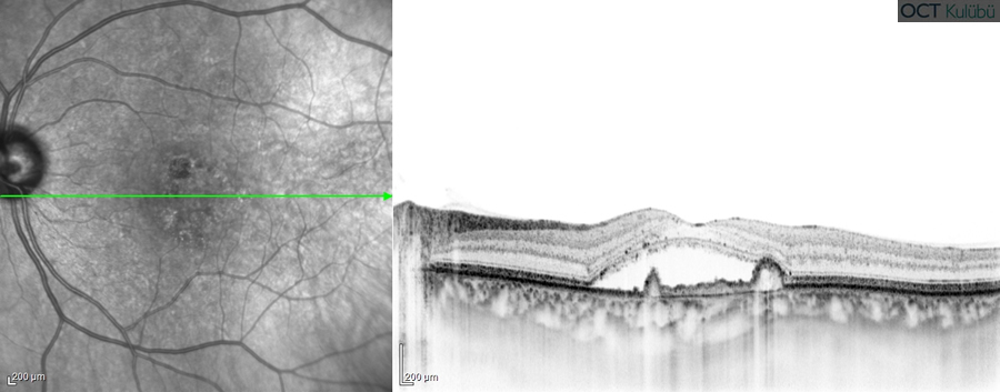 Polipoidal Koroidal Vaskülopati
Optik koherens tomografi (OCT)