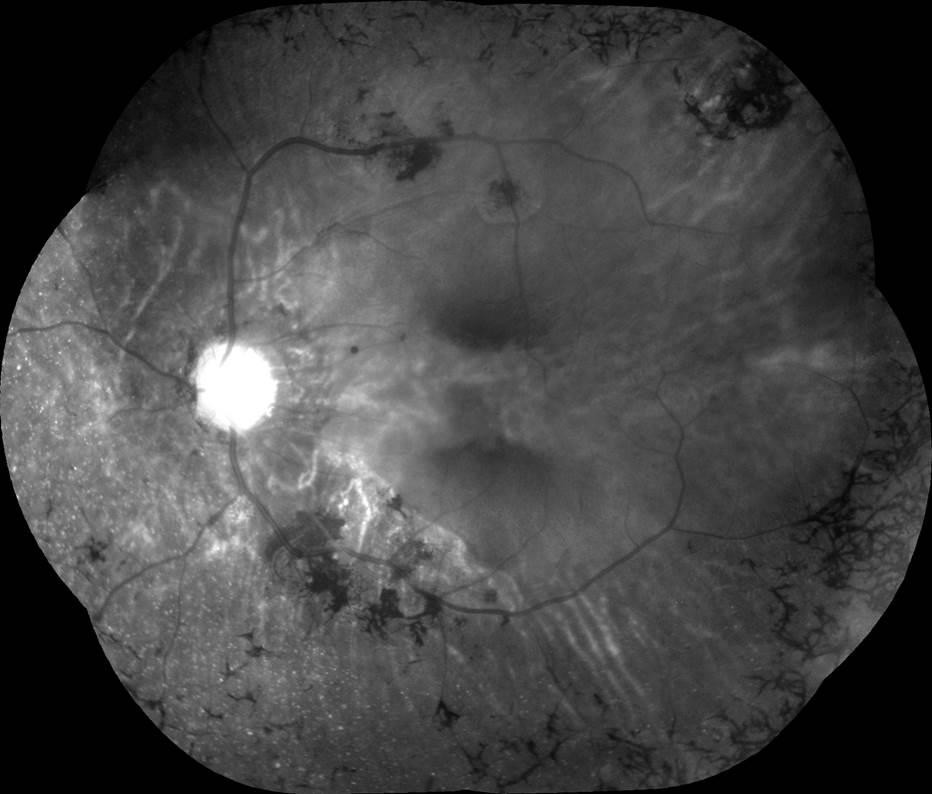 Bietti’nin Kristalin Distrofisi
Kırmızıdan Yoksun Fundus Fotoğrafı