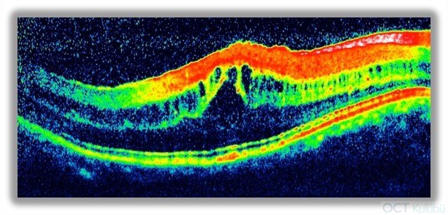 Nanoftalmus Flöresein anjiografi Optik koherens tomografi (OCT)