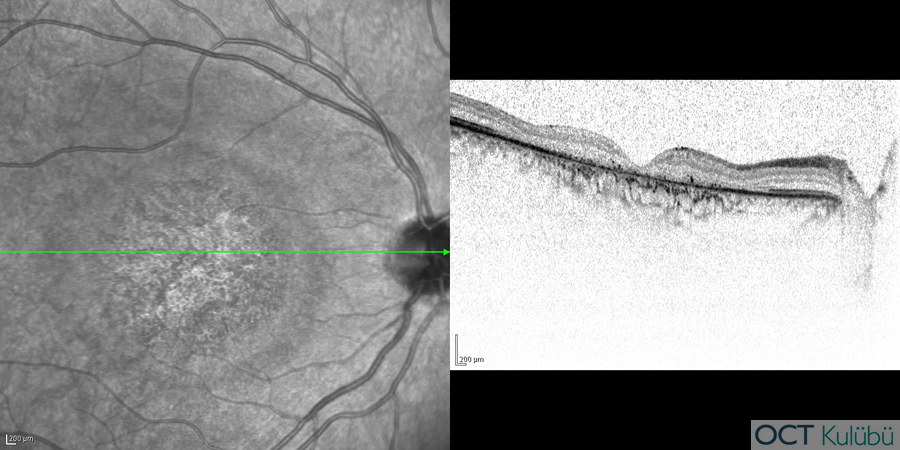 Kon Distrofisi
Optik koherens tomografi (OCT)