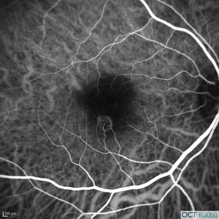 Retinal Anjiomatöz Proliferasyon
İndosiyanin yeşili anjiyografi