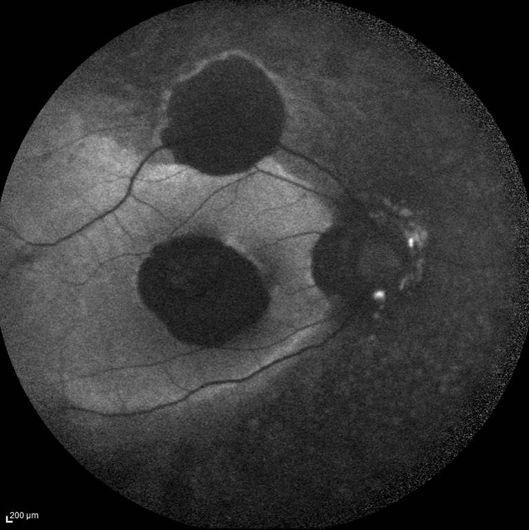 Bietti’nin Kristalin Distrofisi Fundus Otofloresans