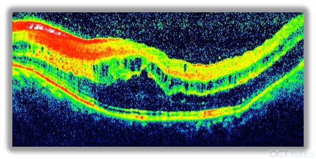 Nanoftalmus Flöresein anjiografi Optik koherens tomografi (OCT)