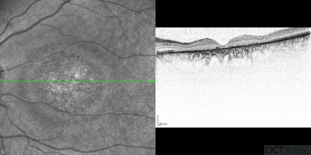 Kon Distrofisi
Optik koherens tomografi (OCT)