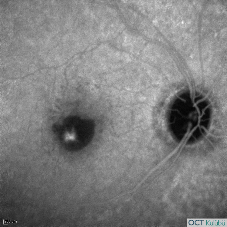 Retinal Anjiomatöz Proliferasyon
İndosiyanin yeşili anjiyografi