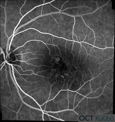 Polipoidal Koroidal Vaskülopati
Flöresein Anjiografi