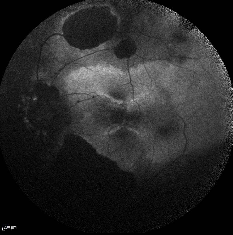 Bietti’nin Kristalin Distrofisi Fundus Otofloresans