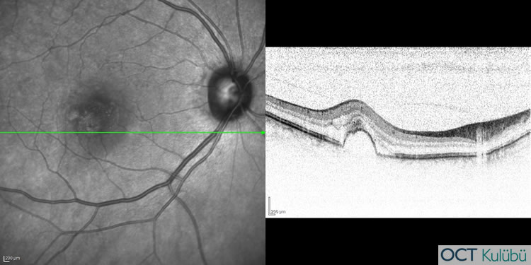 Retinal Anjiomatöz Proliferasyon
OCT