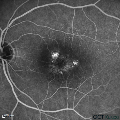 Polipoidal Koroidal Vaskülopati
Flöresein Anjiografi