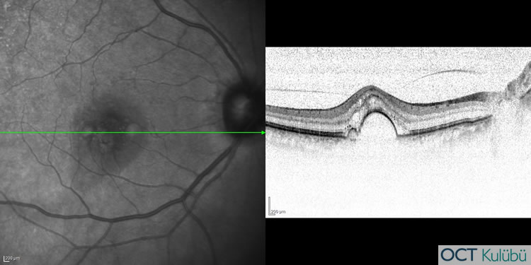 Retinal Anjiomatöz Proliferasyon
OCT