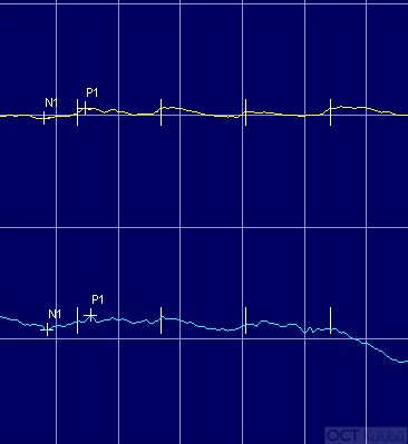 Kon Distrofisi
Elektrofizyolojik Testler