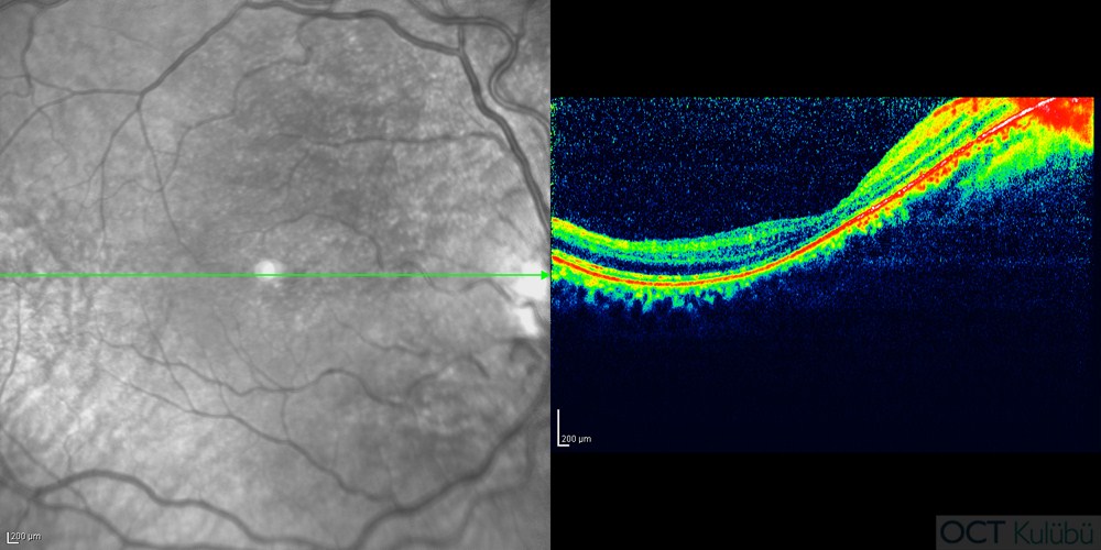 Familial Foveal Retinoskizis
optik koherens tomografi