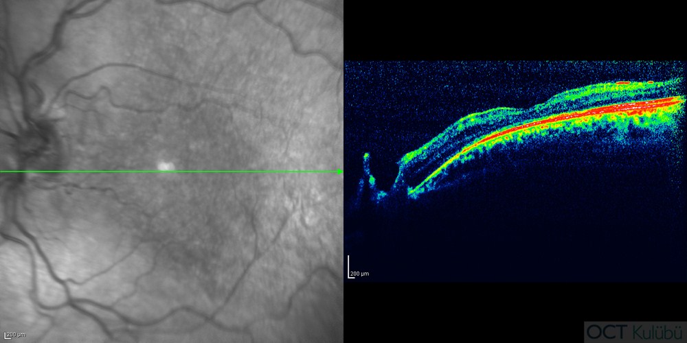 Familial Foveal Retinoskizis
optik koherens tomografi