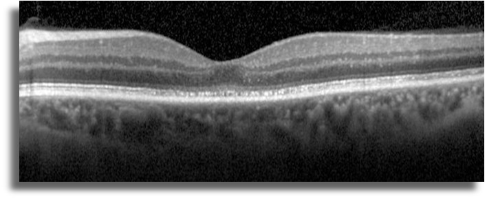 Non-Neoplastik Otoimmün Retinopati  OCT