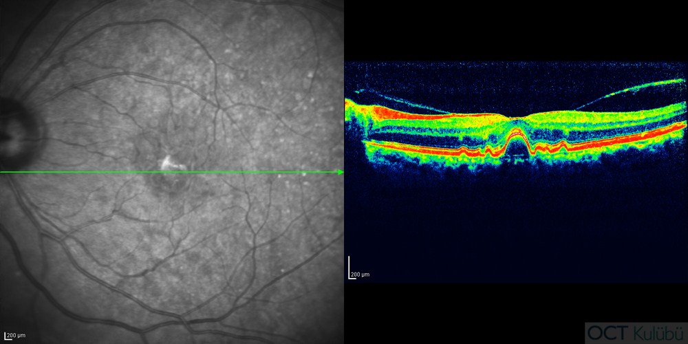 oct yaşa bağlı makula dejenerasyonu vitreomaküler traksiyon