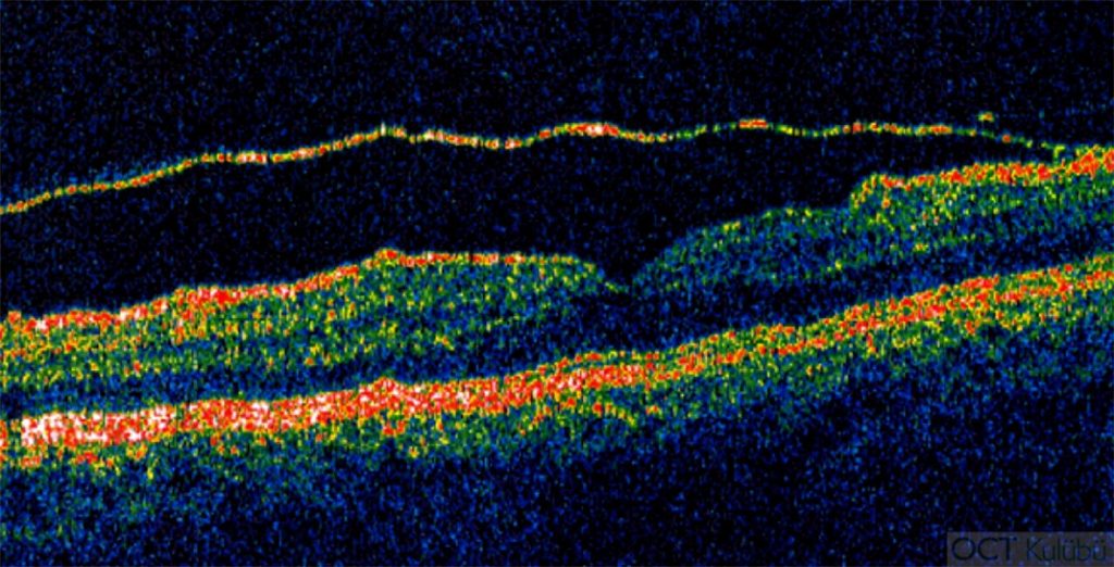 Valsalva Retinopati Sekeli OCT