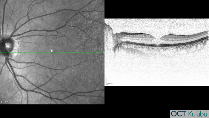 Akut Maküler Nöroretinopati Optik koherens tomografi