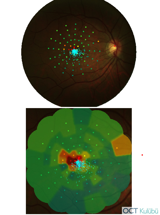 Akut Maküler Nöroretinopati Mikroperimetri