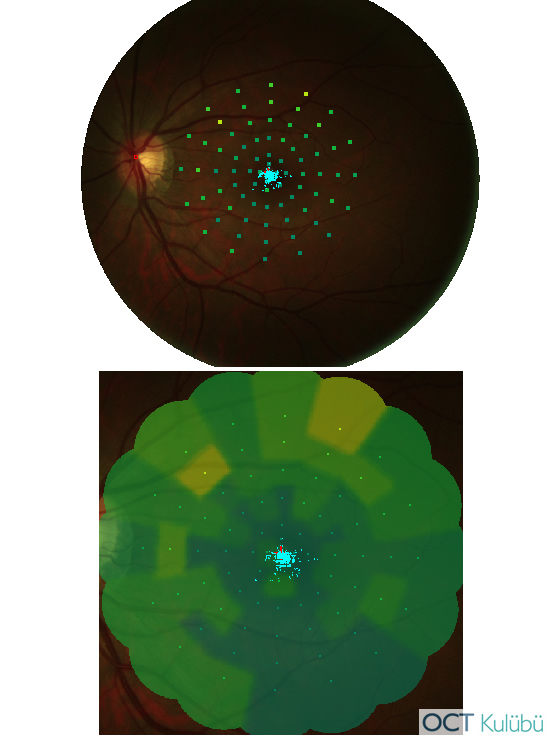 Akut Maküler Nöroretinopati Mikroperimetri