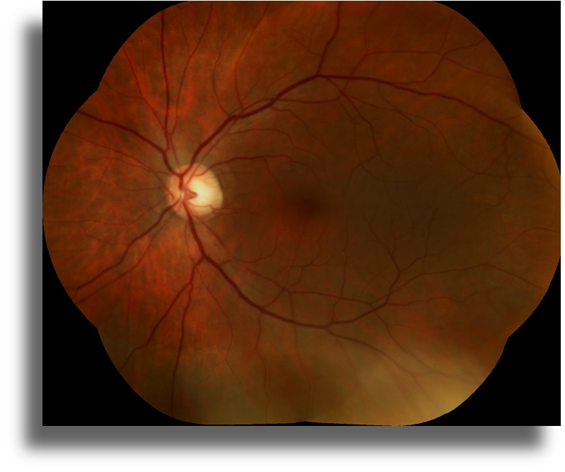 Non-Neoplastik Otoimmün Retinopati