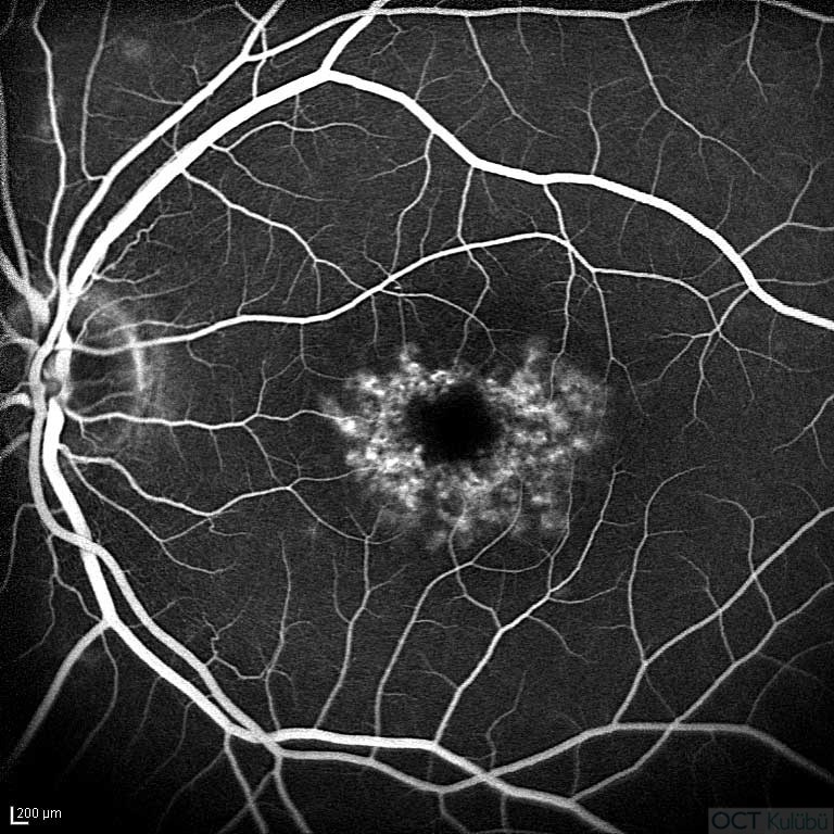 Benign Konsantrik Anüler Maküler Distrofi  Flöresein anjiografi