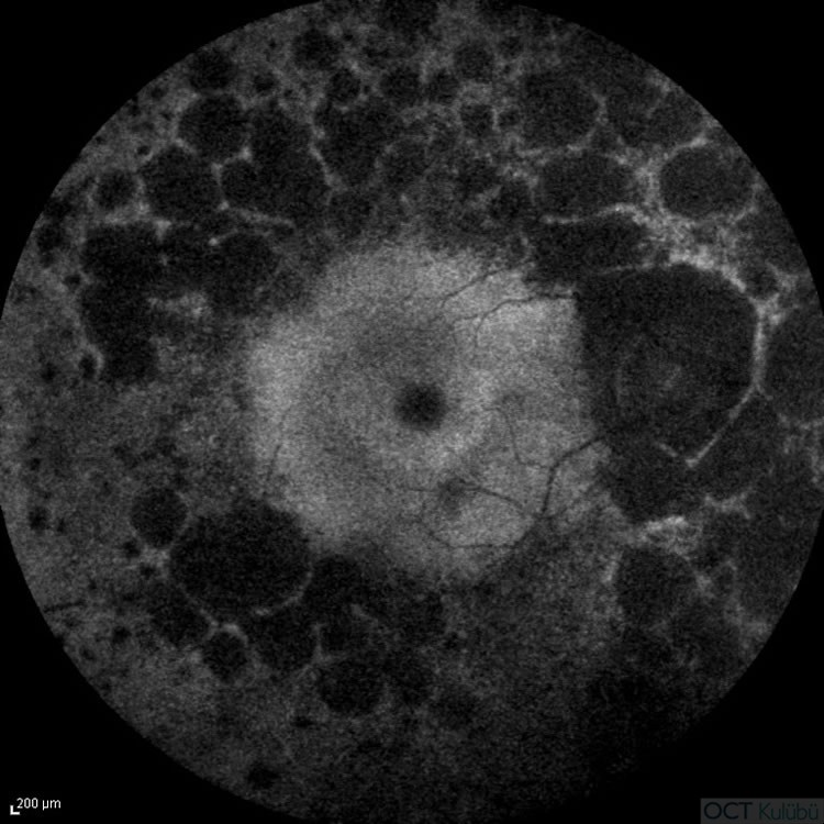 Retinitis Pigmentosa
Fundus Otoflöresans 