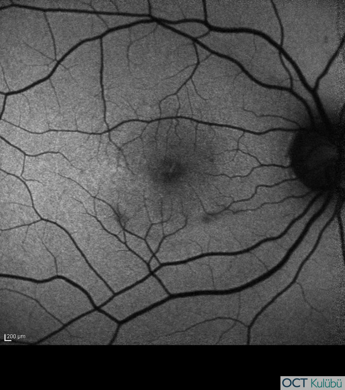 Akut Maküler Nöroretinopati
Fundus otoflöresans