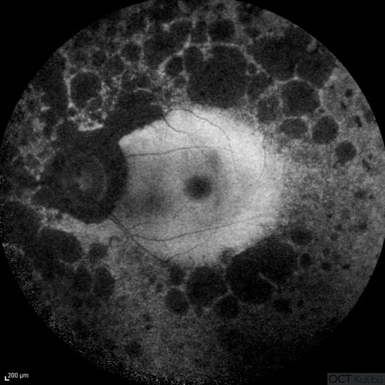 Retinitis Pigmentosa
Fundus Otoflöresans 