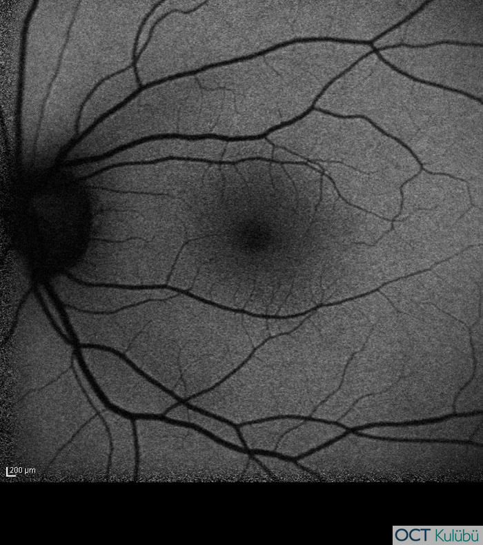 Akut Maküler Nöroretinopati
Fundus otoflöresans