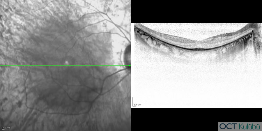 Retinitis Pigmentosa
Optik koherens tomografi (OCT)