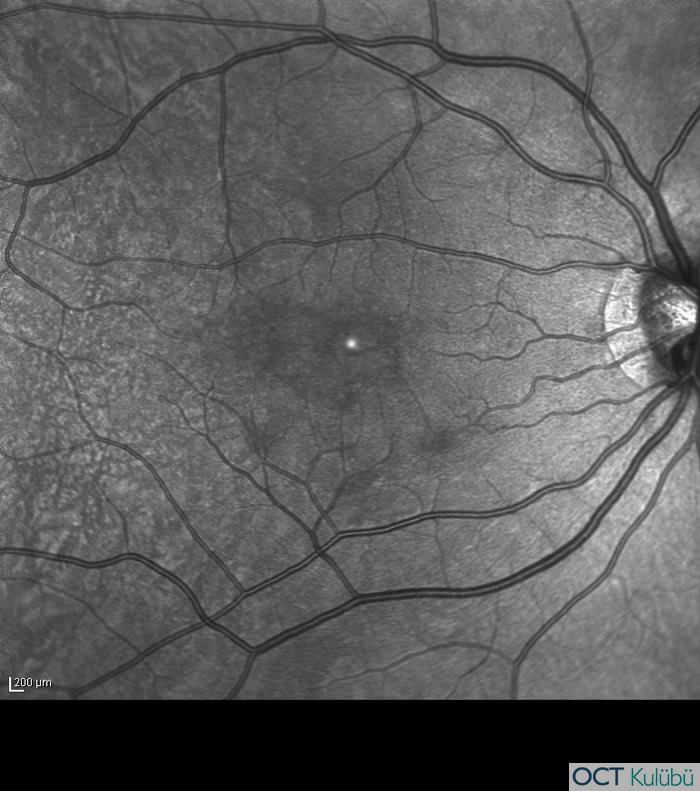 Akut Maküler Nöroretinopati
Kızılötesi fundus görüntüsü