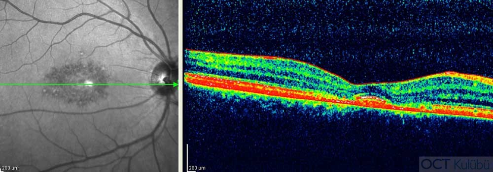 Benign Konsantrik Anüler Maküler Distrofi  optik koherens tomografi 