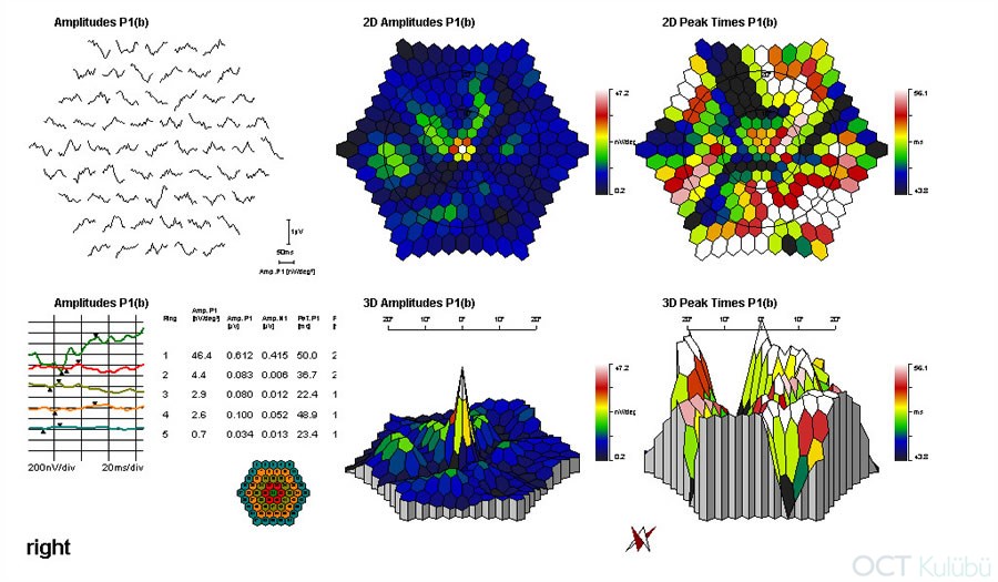 Elektrofizyolojik Testler
Retinitis Pigmentosa