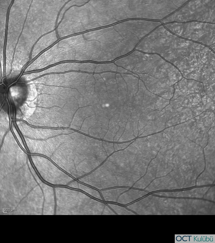 Akut Maküler Nöroretinopati
Kızılötesi fundus görüntüsü