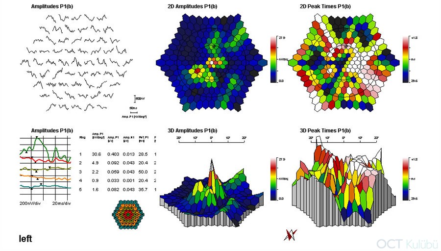 Elektrofizyolojik Testler
Retinitis Pigmentosa
