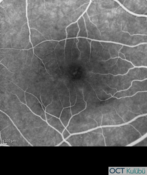 Akut Maküler Nöroretinopati Flöresein anjiyografi