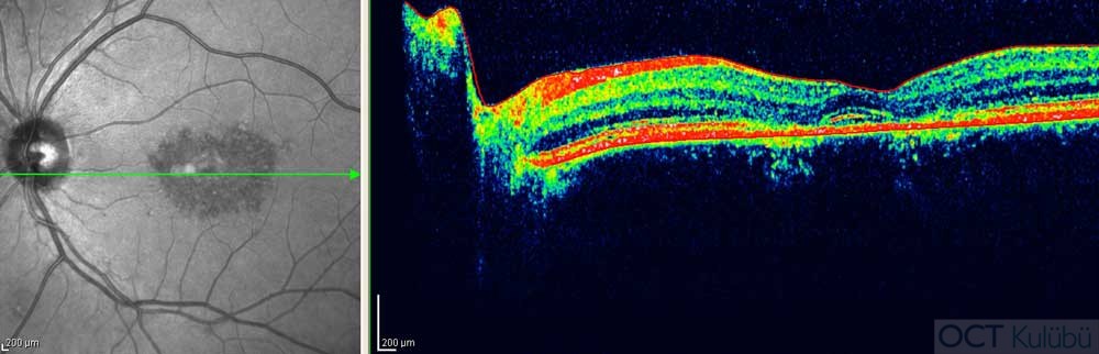Benign Konsantrik Anüler Maküler Distrofi  optik koherens tomografi 