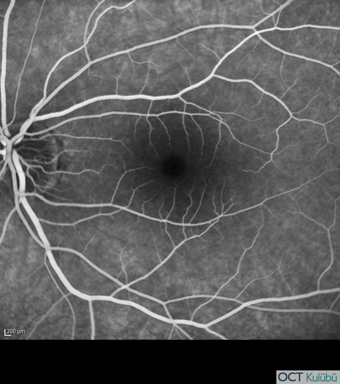 Akut Maküler Nöroretinopati Flöresein anjiyografi