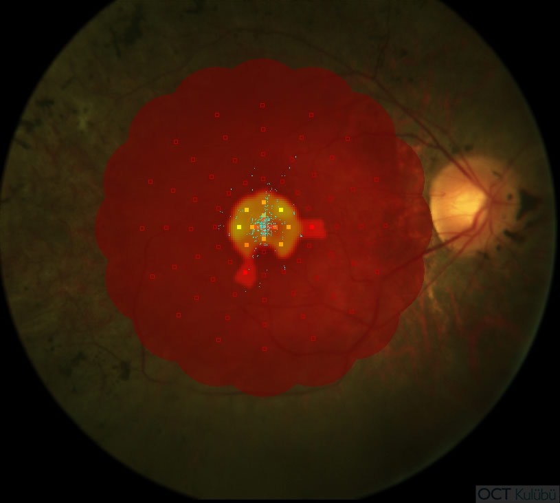 Mikroperimetri
Retinitis Pigmentosa